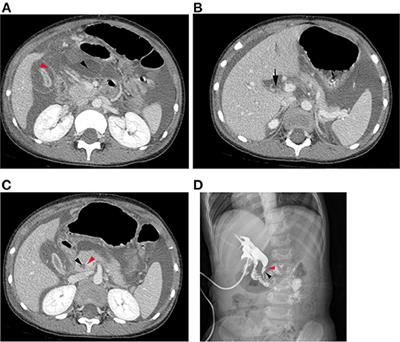 Analysis of the Clinical Characteristics of Spontaneous Bile Duct Perforation in Children